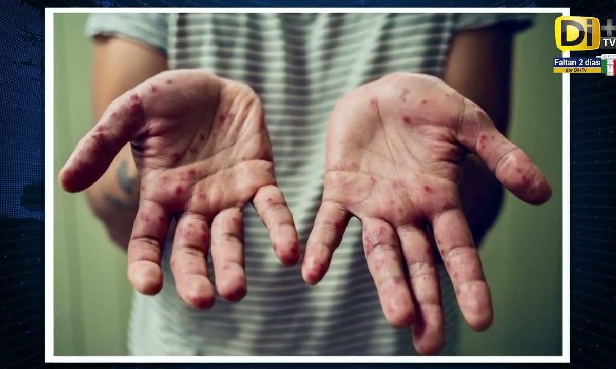 CONFIRMAN CASOS DE COXSACKIE EN ESCUELAS DE PUEBLA