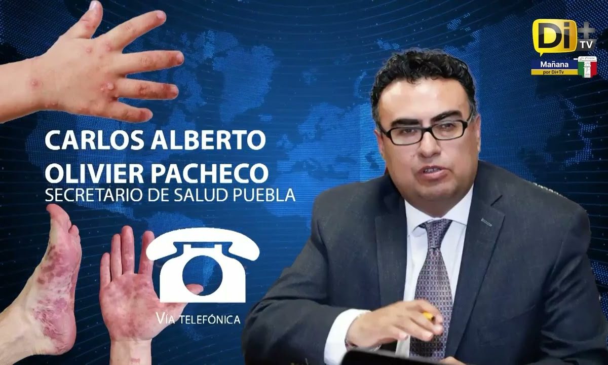 CONFIRMA SALUD MÁS CASOS DE COXSACKIE AHORA EN LIBRES Y TLACHICHUCA