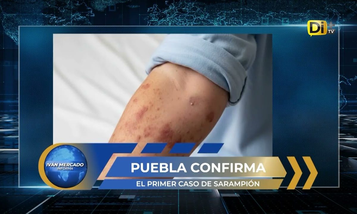 ¡PUEBLA EN ALERTA POR SARAMPIÓN!