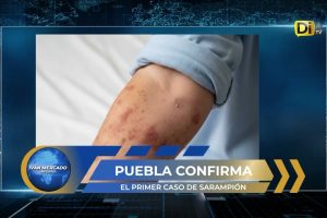 ¡PUEBLA EN ALERTA POR SARAMPIÓN!