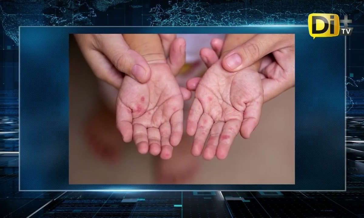 CASOS DE SARAMPIÓN CAEN SESENTA POR CIENTO