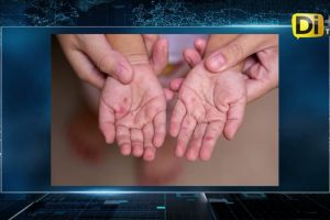 CASOS DE SARAMPIÓN CAEN SESENTA POR CIENTO