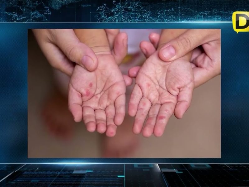 CASOS DE SARAMPIÓN CAEN SESENTA POR CIENTO